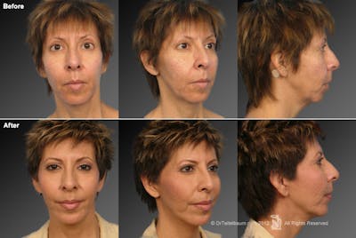 Chin Augmentation Before & After Gallery - Patient 106009396 - Image 1