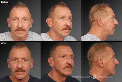 Chin Augmentation Before & After Gallery - Patient 106009398 - Image 1