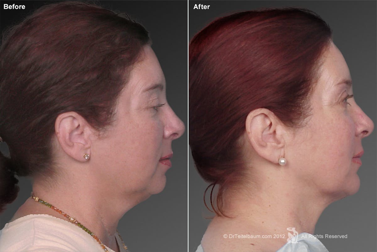 Chin Augmentation Before & After Gallery - Patient 106017402 - Image 1