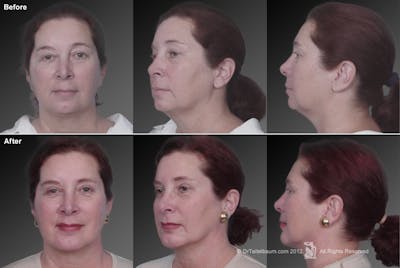 Chin Augmentation Before & After Gallery - Patient 106038105 - Image 1