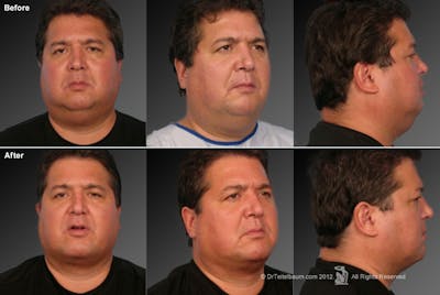 Chin Augmentation Before & After Gallery - Patient 106038106 - Image 1