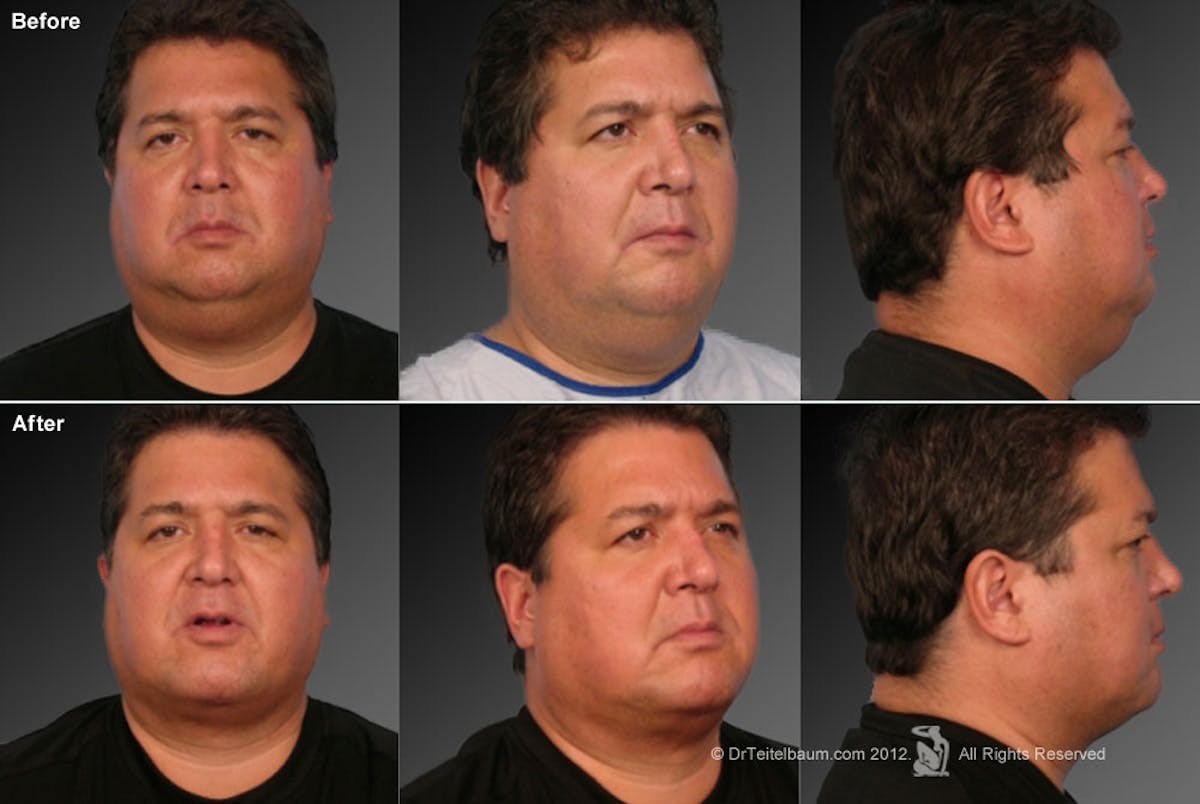 Chin Augmentation Before & After Gallery - Patient 106038106 - Image 1