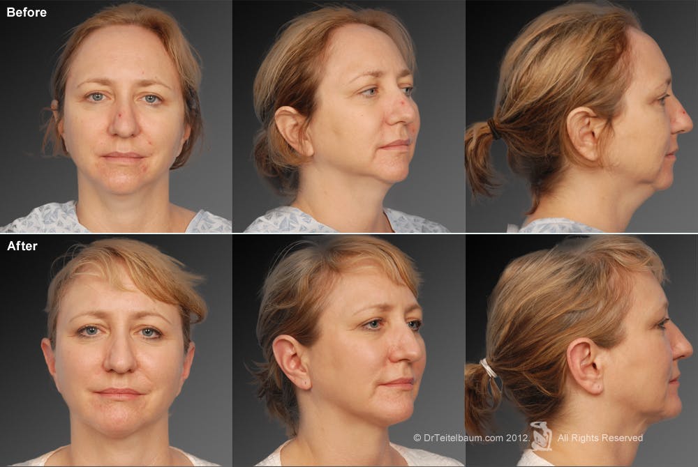 Chin Augmentation Before & After Gallery - Patient 106038107 - Image 1