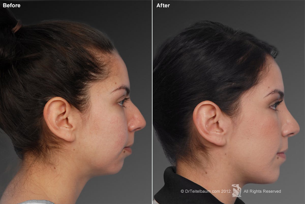 Chin Augmentation Before & After Gallery - Patient 106038108 - Image 1