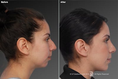 Chin Augmentation Before & After Gallery - Patient 106038108 - Image 1