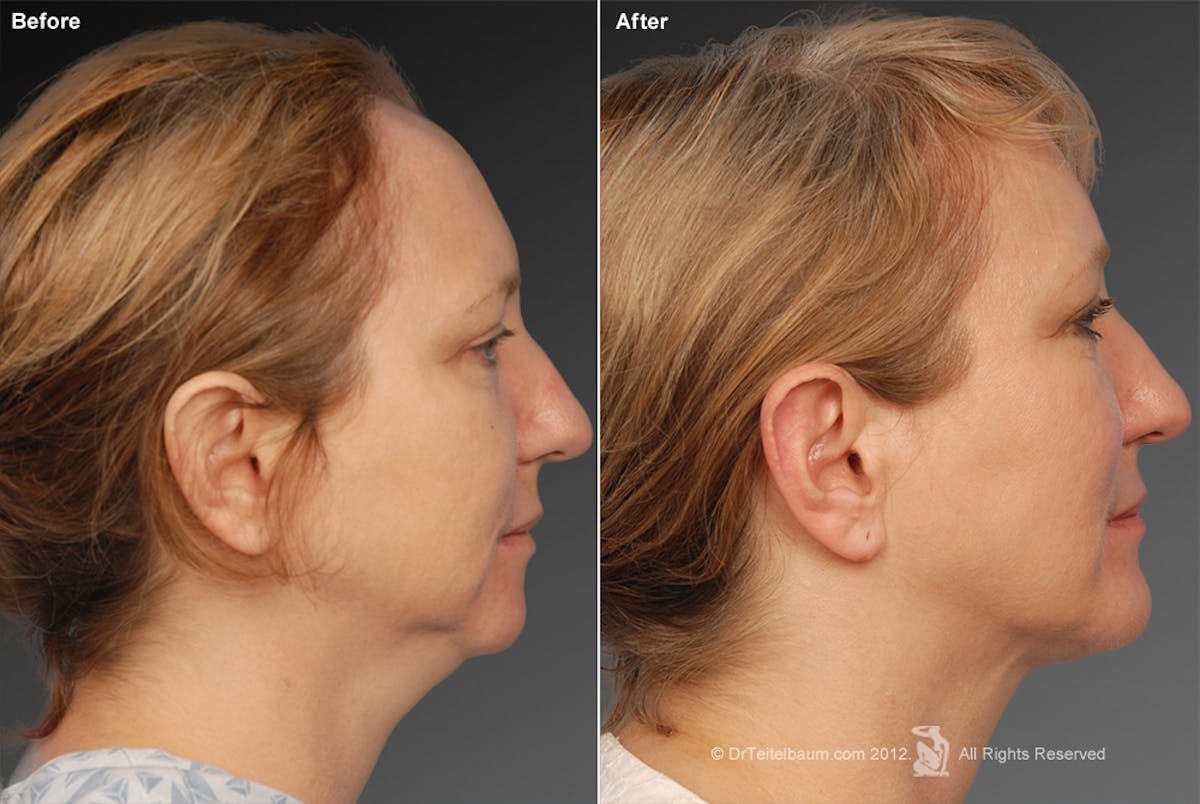 Chin Augmentation Before & After Gallery - Patient 106038109 - Image 1