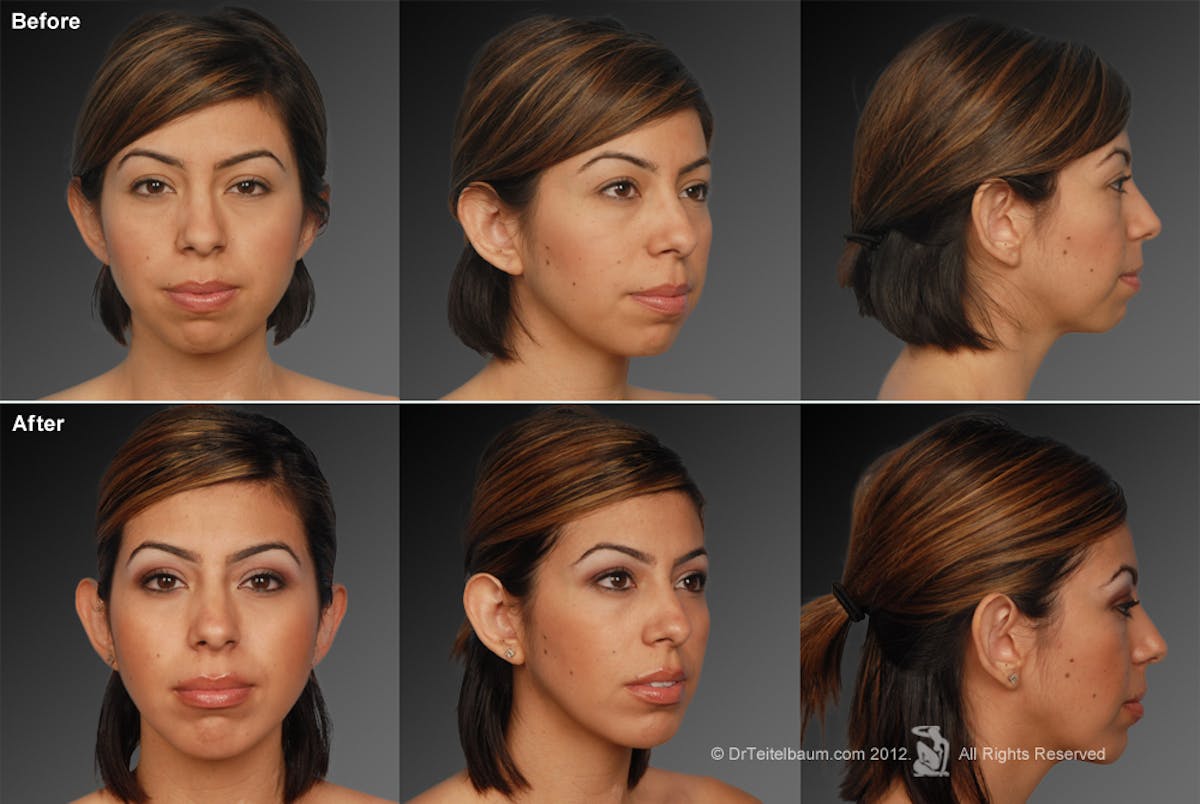 Chin Augmentation Before & After Gallery - Patient 106038110 - Image 1
