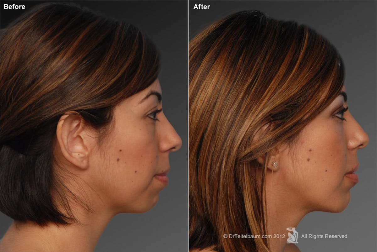 Chin Augmentation Before & After Gallery - Patient 106038111 - Image 1