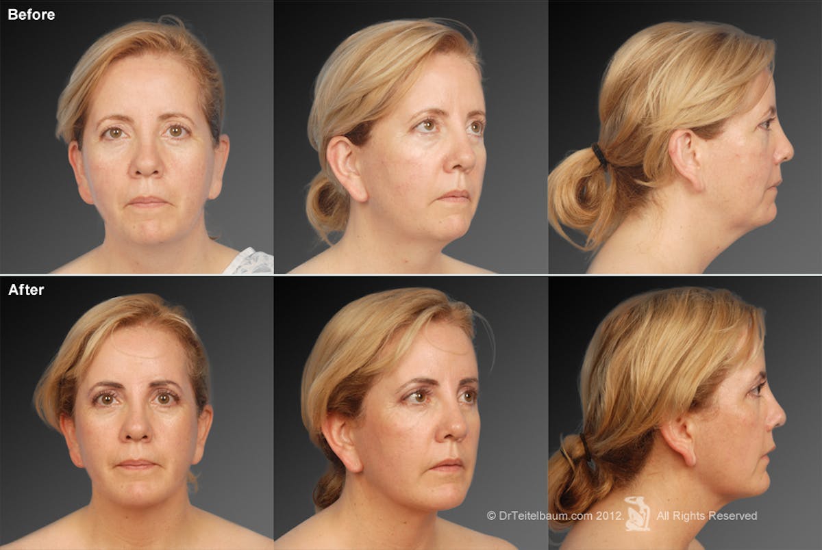 Chin Augmentation Before & After Gallery - Patient 106038112 - Image 1