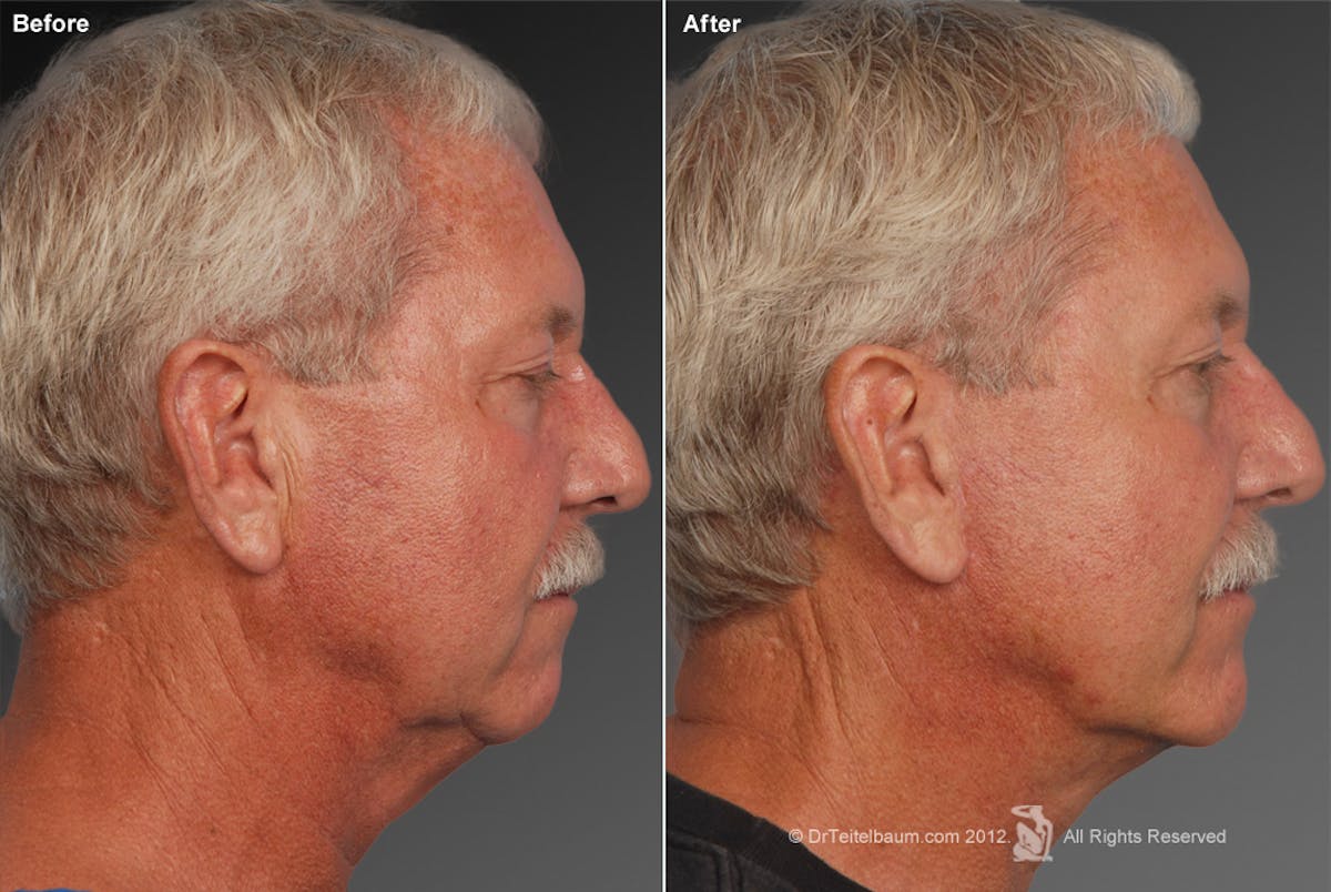 Chin Augmentation Before & After Gallery - Patient 106038114 - Image 1