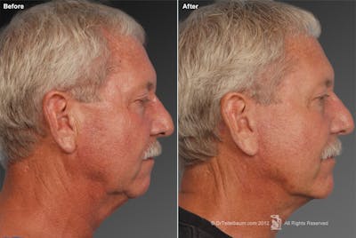 Chin Augmentation Before & After Gallery - Patient 106038114 - Image 1