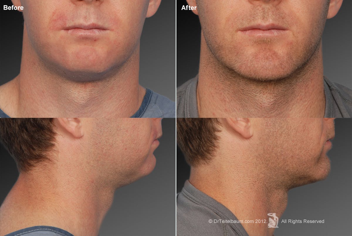 Chin Augmentation Before & After Gallery - Patient 106038115 - Image 1
