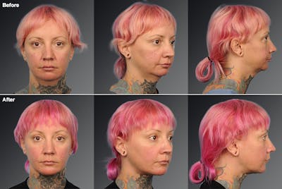 Chin Augmentation Before & After Gallery - Patient 106038116 - Image 1
