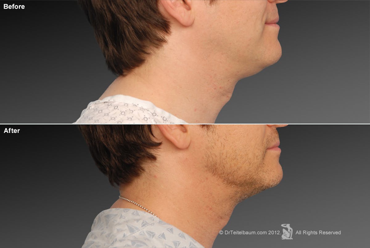 Neck Liposuction Before & After Gallery - Patient 106041368 - Image 1
