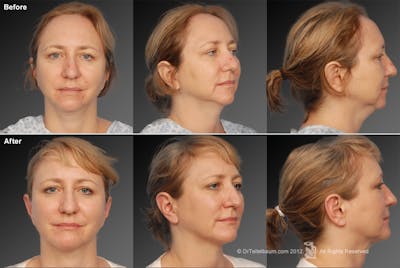 Neck Liposuction Before & After Gallery - Patient 106041369 - Image 1