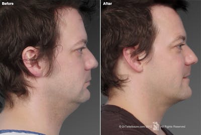 Neck Liposuction Before & After Gallery - Patient 106041371 - Image 1