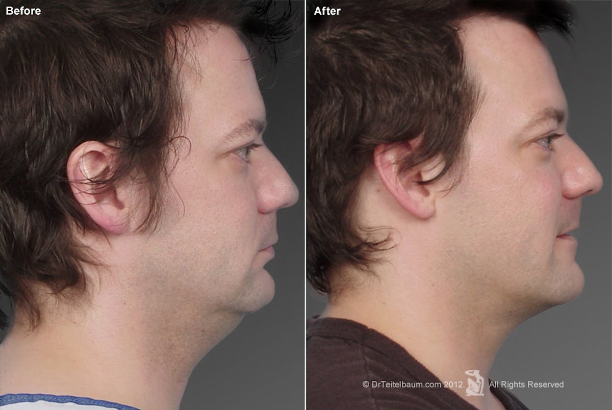 Neck Liposuction Before & After Gallery - Patient 106041371 - Image 1