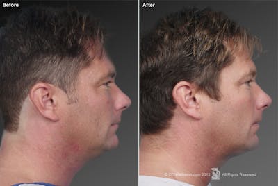 Neck Liposuction Before & After Gallery - Patient 106041373 - Image 1