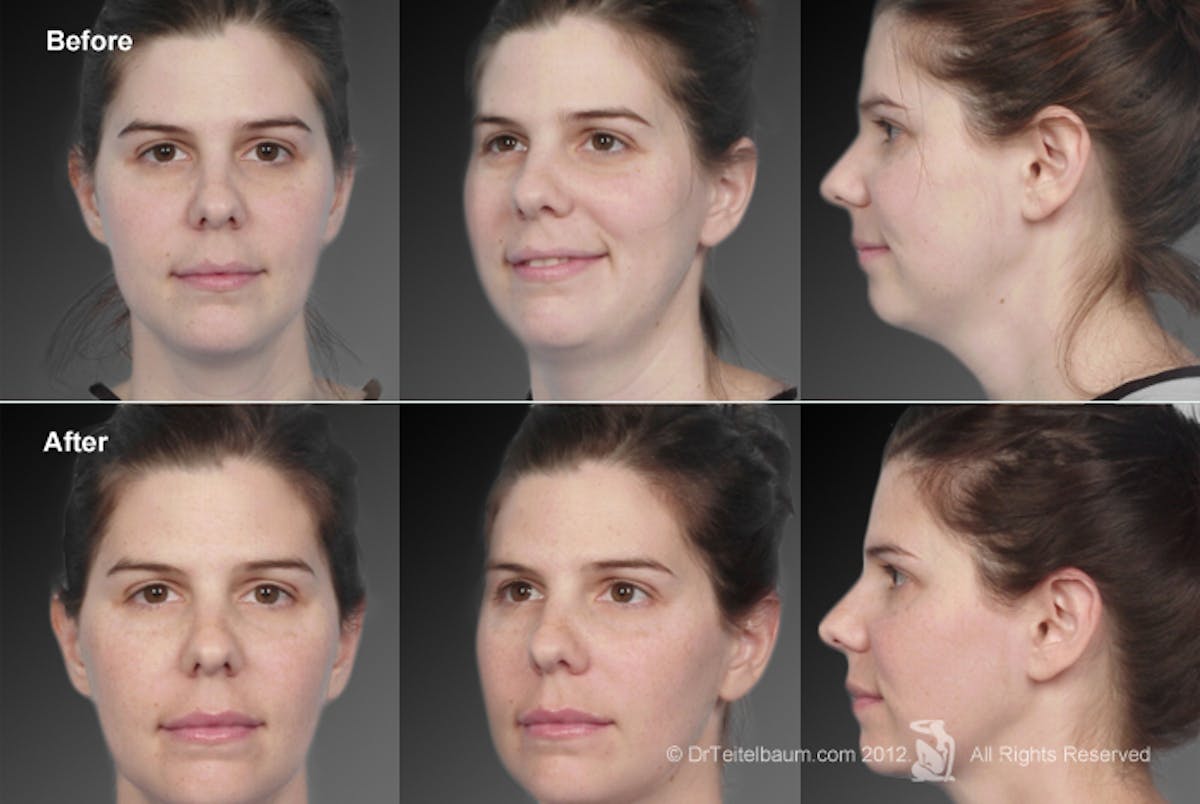 Neck Liposuction Before & After Gallery - Patient 106041375 - Image 1