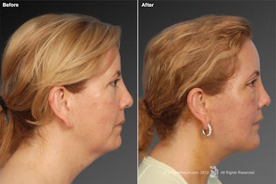Neck Liposuction Before & After Gallery - Patient 106041378 - Image 1
