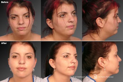 Neck Liposuction Before & After Gallery - Patient 106041379 - Image 1