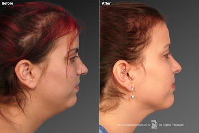 Neck Liposuction Before & After Gallery - Patient 106041380 - Image 1