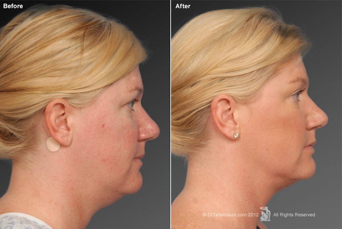 Neck Liposuction Before & After Gallery - Patient 106041381 - Image 1