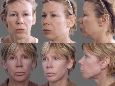 Neck Liposuction Before & After Gallery - Patient 106041382 - Image 1