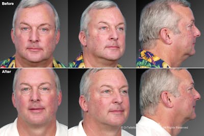 Neck Liposuction Before & After Gallery - Patient 106041383 - Image 1