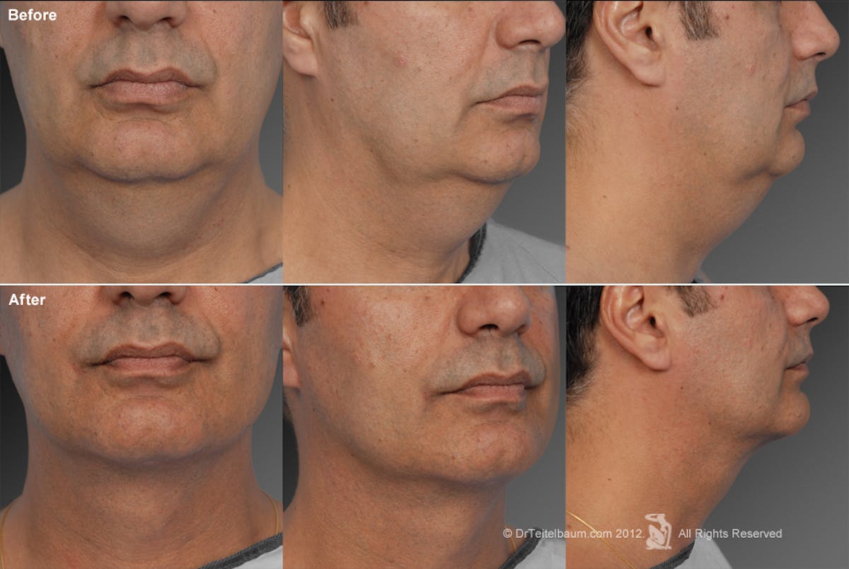 Neck Liposuction Before & After Gallery - Patient 106041384 - Image 1