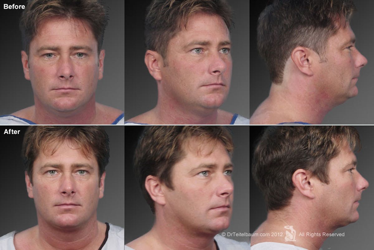 Neck Liposuction Before & After Gallery - Patient 106041387 - Image 1