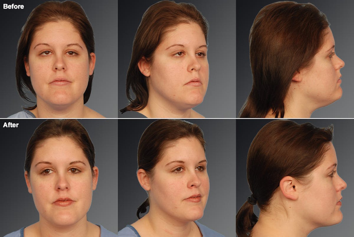 Neck Liposuction Before & After Gallery - Patient 106041390 - Image 1