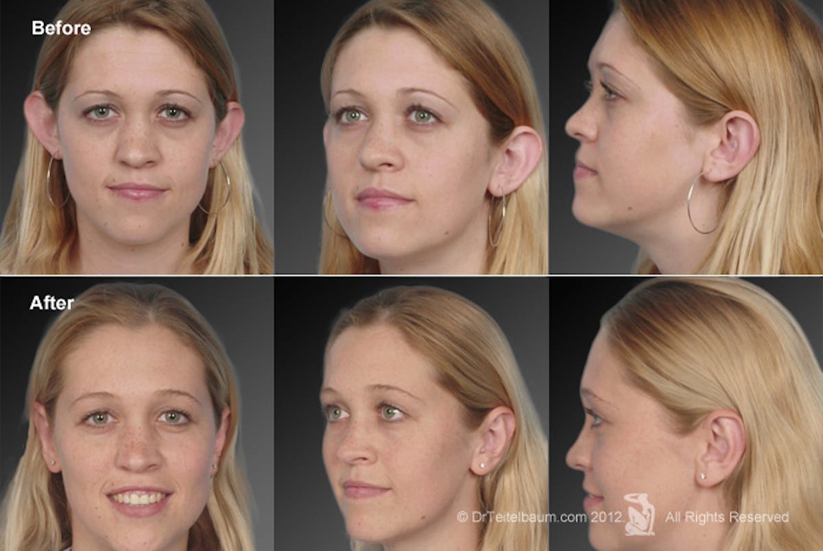 Ears (Otoplasty) Before & After Gallery - Patient 106041428 - Image 1