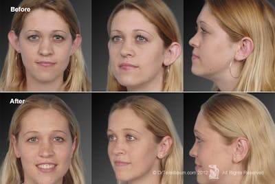 Ears (Otoplasty) Before & After Gallery - Patient 106041428 - Image 1