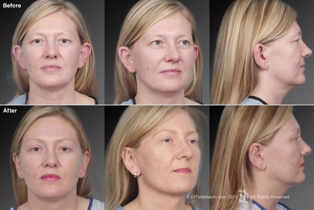 Ears (Otoplasty) Before & After Gallery - Patient 106041429 - Image 1