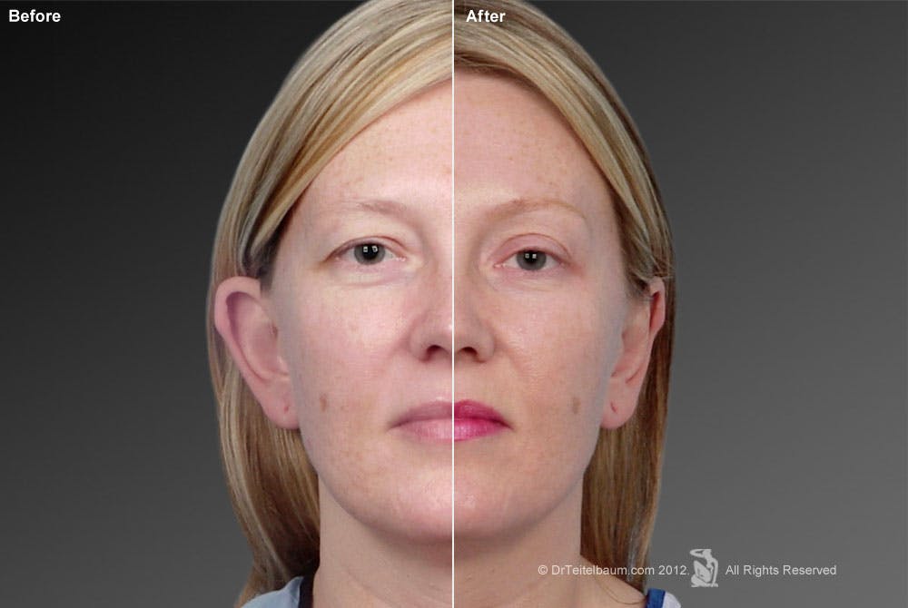 Ears (Otoplasty) Before & After Gallery - Patient 106041431 - Image 1