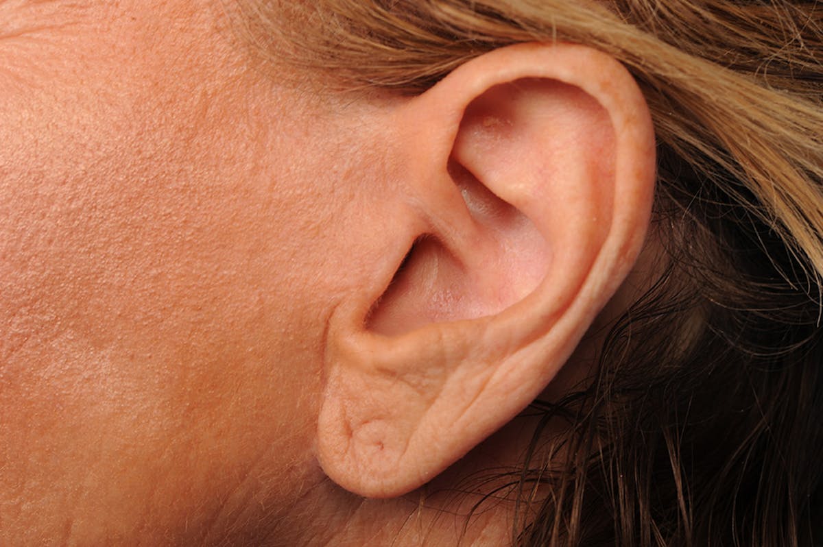 Facelift Scar Closeups Before & After Gallery - Patient 106041435 - Image 1