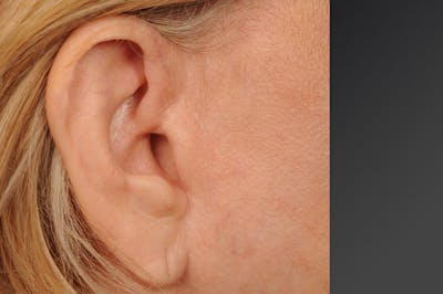 Facelift Scar Closeups Before & After Gallery - Patient 106041436 - Image 1