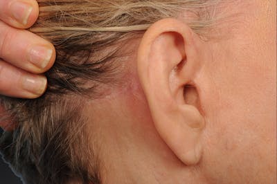 Facelift Scar Closeups Before & After Gallery - Patient 106041437 - Image 1