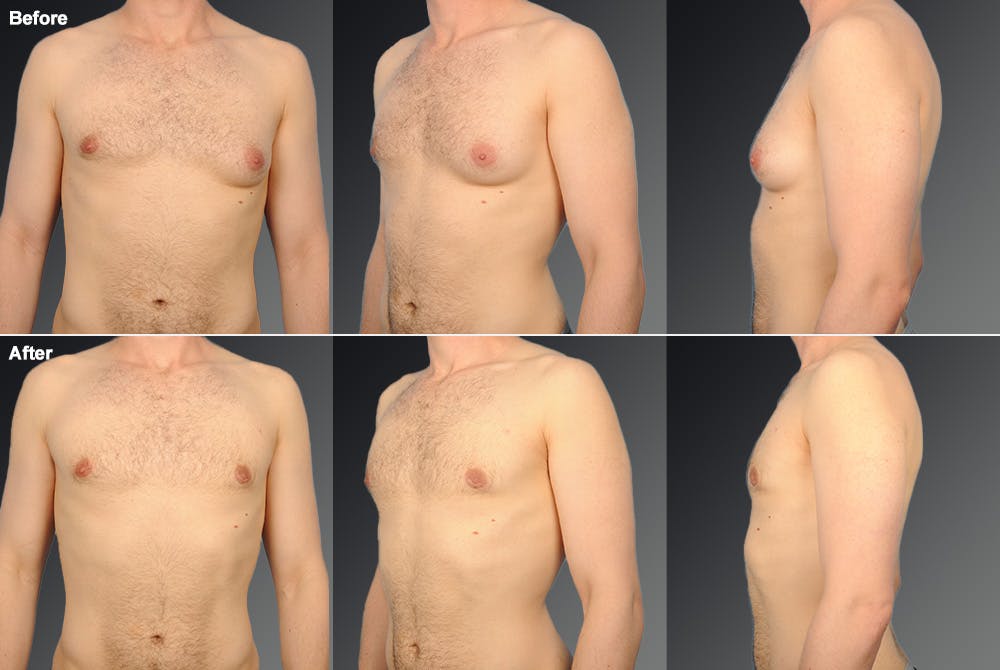 Chest (Gynecomastia) Before & After Gallery - Patient 106041440 - Image 1