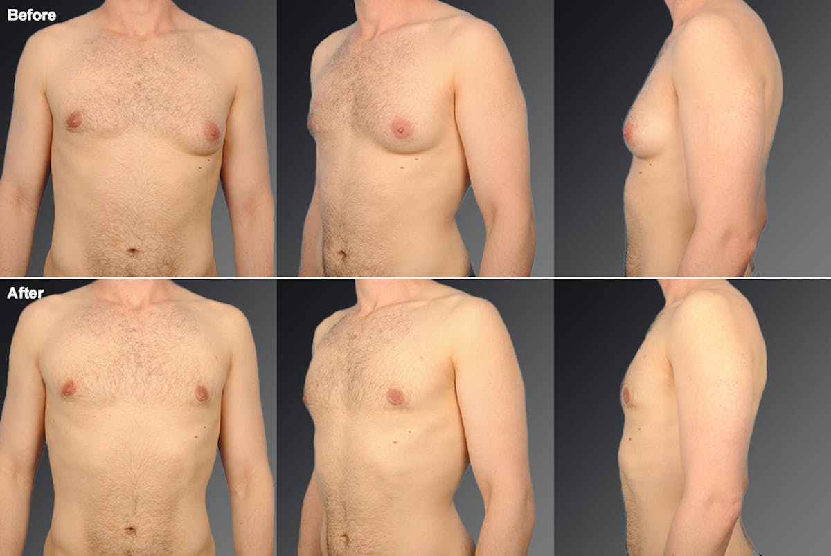 Chest (Gynecomastia) Before & After Gallery - Patient 106041440 - Image 1