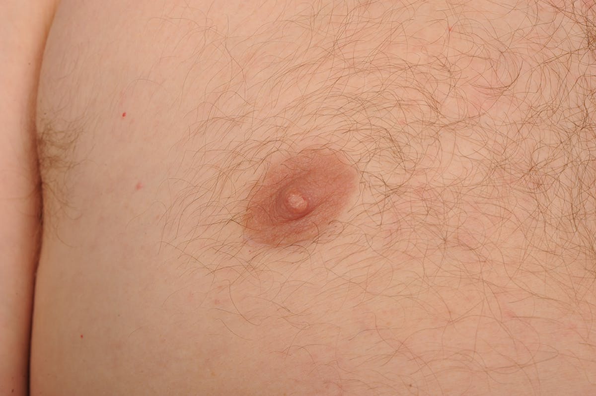 Chest (Gynecomastia) Before & After Gallery - Patient 106041442 - Image 1