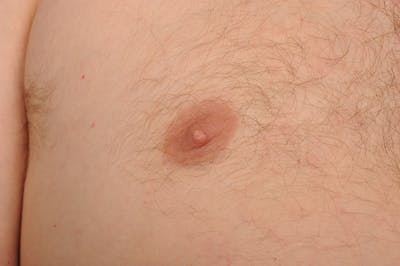 Chest (Gynecomastia) Before & After Gallery - Patient 106041442 - Image 1