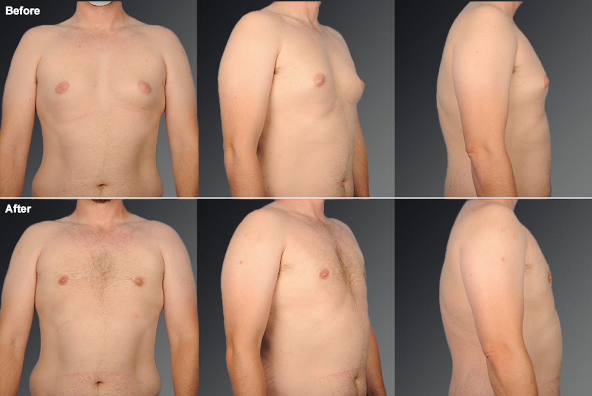 Chest (Gynecomastia) Before & After Gallery - Patient 106041443 - Image 1