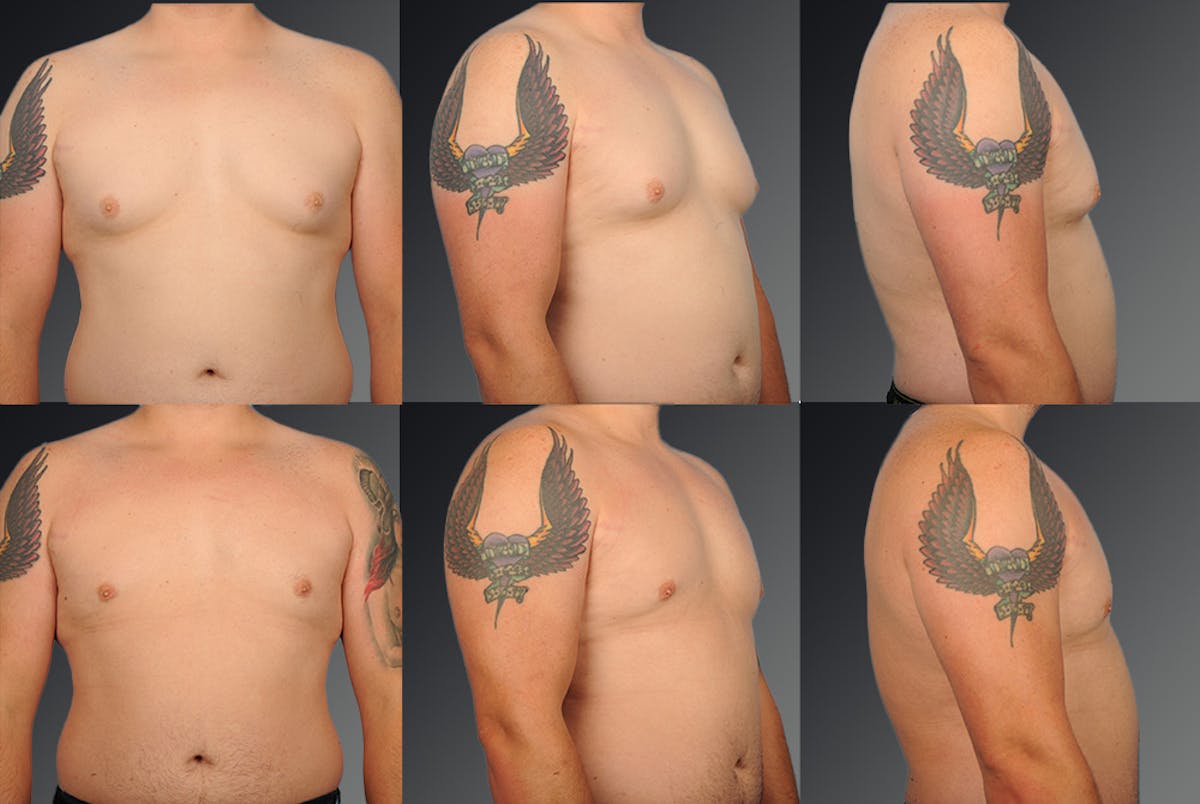 Chest (Gynecomastia) Before & After Gallery - Patient 106041444 - Image 1