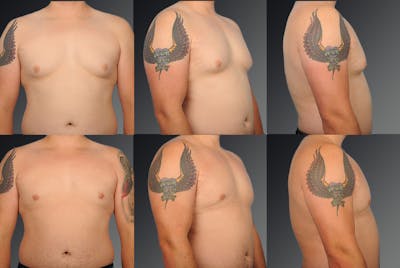Chest (Gynecomastia) Before & After Gallery - Patient 106041444 - Image 1