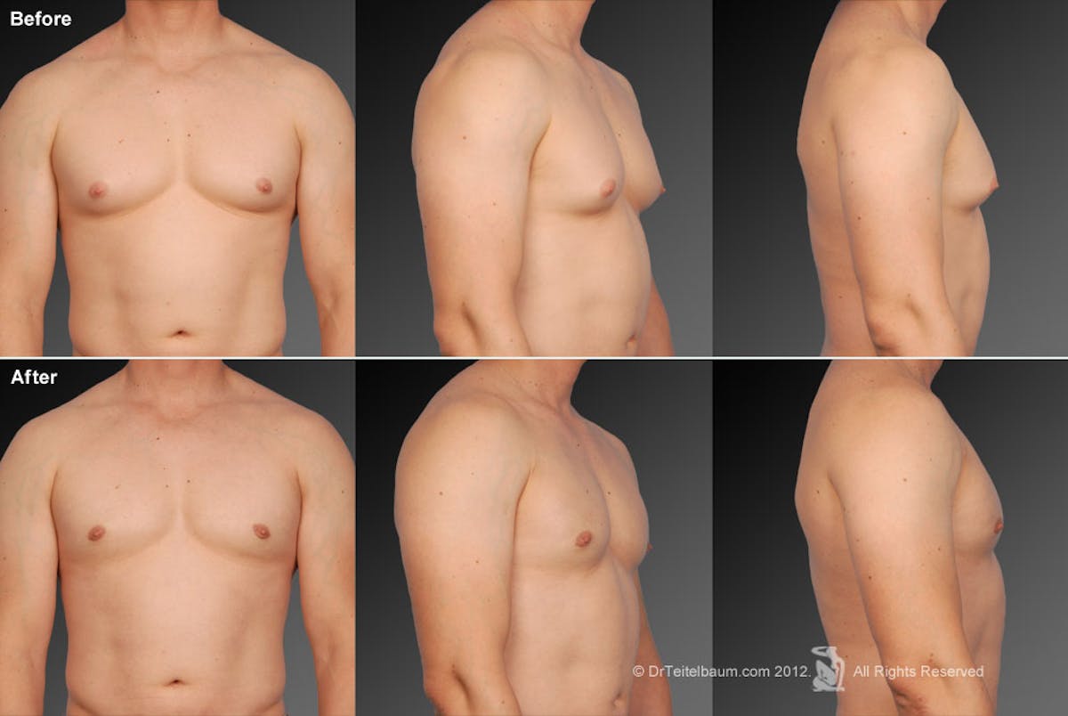 Chest (Gynecomastia) Before & After Gallery - Patient 106041447 - Image 1
