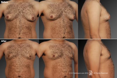 Chest (Gynecomastia) Before & After Gallery - Patient 106041448 - Image 1