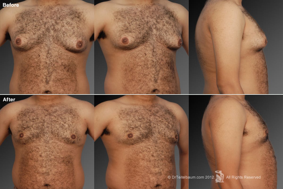Chest (Gynecomastia) Before & After Gallery - Patient 106041448 - Image 1