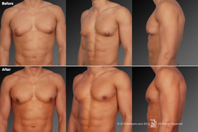 Chest (Gynecomastia) Before & After Gallery - Patient 106041449 - Image 1
